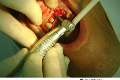Reabilitação com Implantes em Situações de Colapso Oclusal