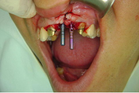 Reabilitação com Implantes em Situações de Colapso Oclusal