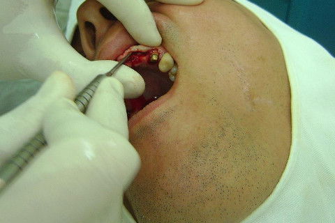 Reabilitação com Implantes em Situações de Colapso Oclusal