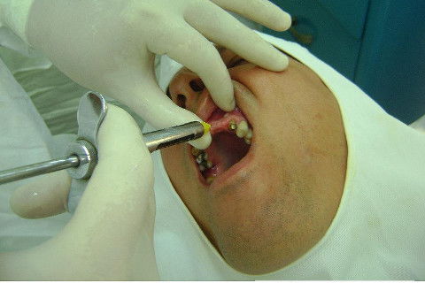 Reabilitação com Implantes em Situações de Colapso Oclusal