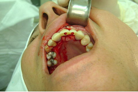 Reabilitação com Implantes em Situações de Colapso Oclusal