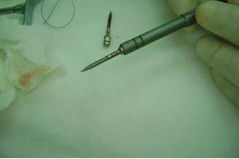 Reabilitação com Implantes em Situações de Colapso Oclusal