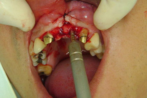 Reabilitação com Implantes em Situações de Colapso Oclusal