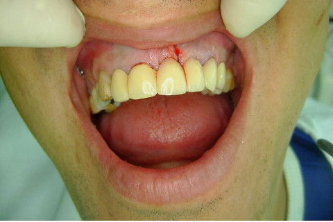 Reabilitação com Implantes em Situações de Colapso Oclusal