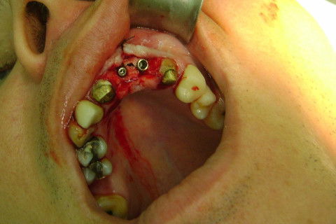 Reabilitação com Implantes em Situações de Colapso Oclusal