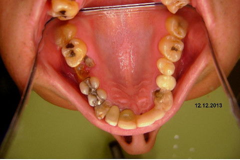 Reabilitação com Implantes em Situações de Colapso Oclusal