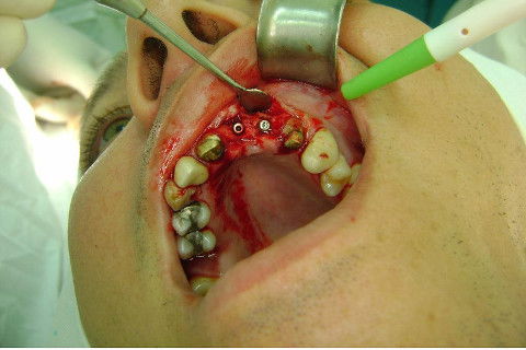 Reabilitação com Implantes em Situações de Colapso Oclusal