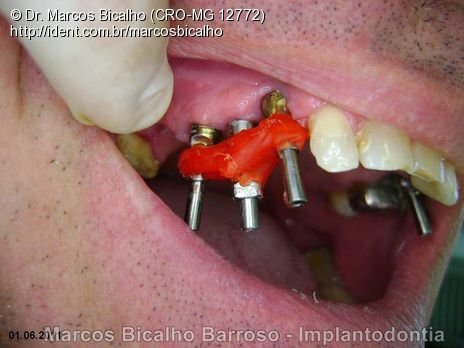 Reabilitação em Maxila com Implantes Após Falência de Ponte Fixa Convencional Sobre Dentes