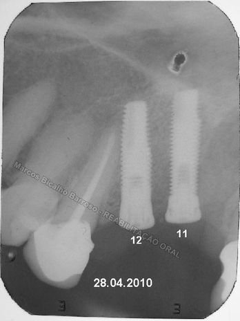 Reabilitação Oral - 10 Implantes Maxila e Mandíbula - Parte Ii - Fixação dos Implantes