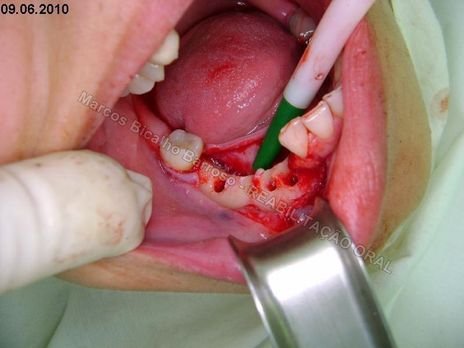 Reabilitação Oral - 10 Implantes Maxila e Mandíbula - Parte Ii - Fixação dos Implantes