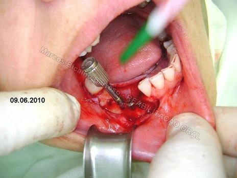 Reabilitação Oral - 10 Implantes Maxila e Mandíbula - Parte Ii - Fixação dos Implantes