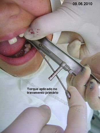 Reabilitação Oral - 10 Implantes Maxila e Mandíbula - Parte Ii - Fixação dos Implantes