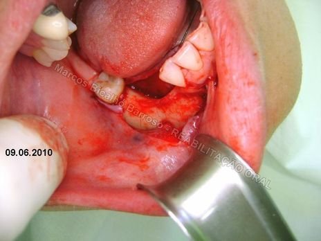 Reabilitação Oral - 10 Implantes Maxila e Mandíbula - Parte Ii - Fixação dos Implantes