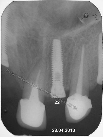 Reabilitação Oral - 10 Implantes Maxila e Mandíbula - Parte Ii - Fixação dos Implantes