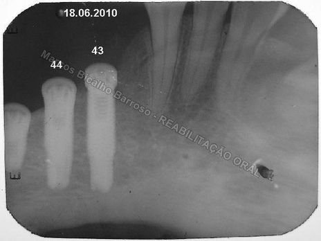 Reabilitação Oral - 10 Implantes Maxila e Mandíbula - Parte Ii - Fixação dos Implantes