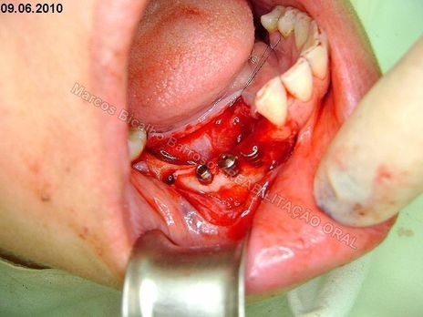 Reabilitação Oral - 10 Implantes Maxila e Mandíbula - Parte Ii - Fixação dos Implantes