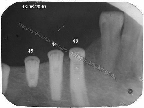 Reabilitação Oral - 10 Implantes Maxila e Mandíbula - Parte Ii - Fixação dos Implantes