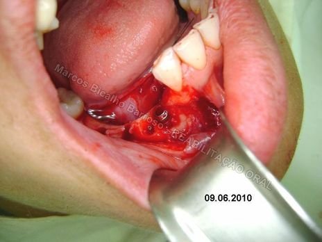 Reabilitação Oral - 10 Implantes Maxila e Mandíbula - Parte Ii - Fixação dos Implantes