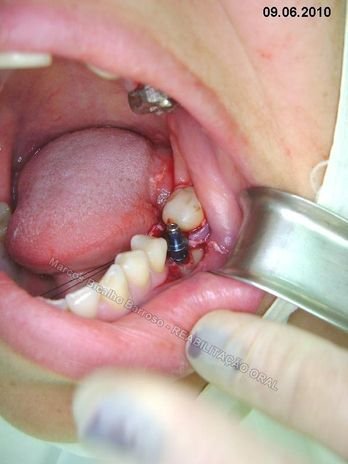 Reabilitação Oral - 10 Implantes Maxila e Mandíbula - Parte Ii - Fixação dos Implantes