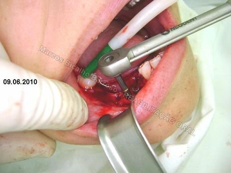 Reabilitação Oral - 10 Implantes Maxila e Mandíbula - Parte Ii - Fixação dos Implantes