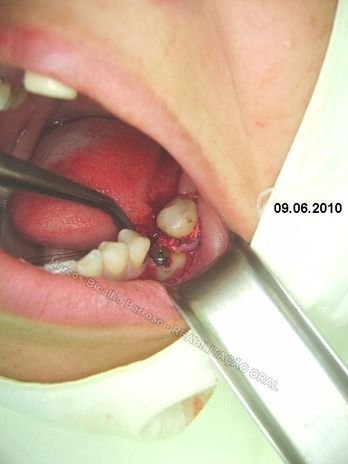 Reabilitação Oral - 10 Implantes Maxila e Mandíbula - Parte Ii - Fixação dos Implantes