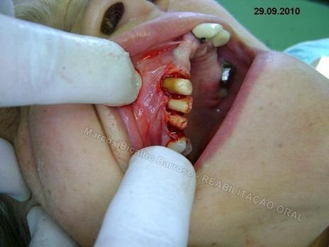 Reabilitação Oral - 10 Implantes Maxila e Mandíbula - Parte Iii - Aumento de Coroa Clínica, Corrigindo Dvo Dentes 13,14,15