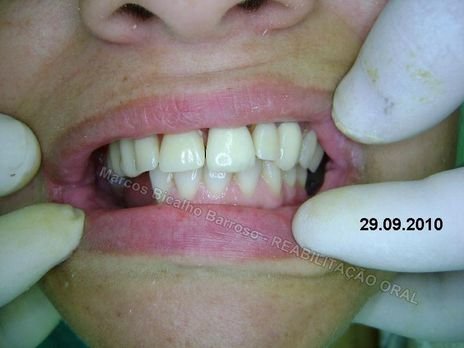 Reabilitação Oral - 10 Implantes Maxila e Mandíbula - Parte Iii - Aumento de Coroa Clínica, Corrigindo Dvo Dentes 13,14,15