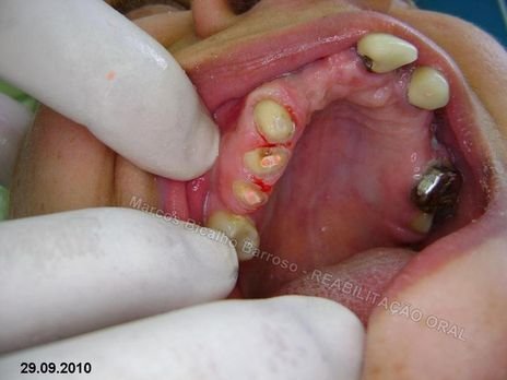 Reabilitação Oral - 10 Implantes Maxila e Mandíbula - Parte Iii - Aumento de Coroa Clínica, Corrigindo Dvo Dentes 13,14,15