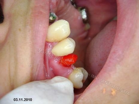 Reabilitação Oral - 10 Implantes Maxila e Mandíbula - Parte Iii - Aumento de Coroa Clínica, Corrigindo Dvo Dentes 13,14,15