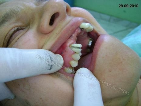 Reabilitação Oral - 10 Implantes Maxila e Mandíbula - Parte Iii - Aumento de Coroa Clínica, Corrigindo Dvo Dentes 13,14,15