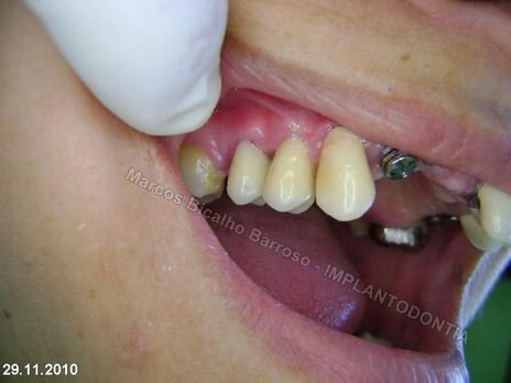 Reabilitação Oral - 10 Implantes Maxila e Mandíbula - Parte Iii - Aumento de Coroa Clínica, Corrigindo Dvo Dentes 13,14,15