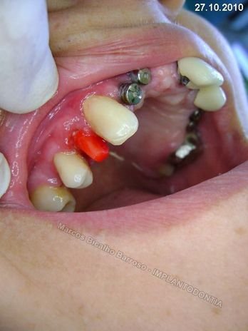 Reabilitação Oral - 10 Implantes Maxila e Mandíbula - Parte Iii - Aumento de Coroa Clínica, Corrigindo Dvo Dentes 13,14,15