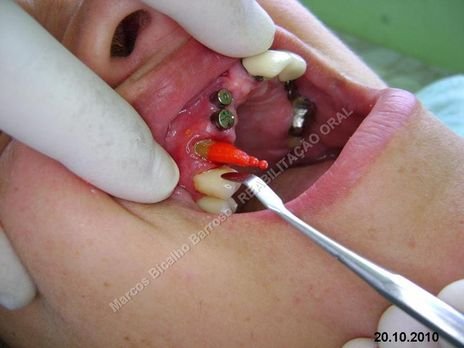 Reabilitação Oral - 10 Implantes Maxila e Mandíbula - Parte Iii - Aumento de Coroa Clínica, Corrigindo Dvo Dentes 13,14,15