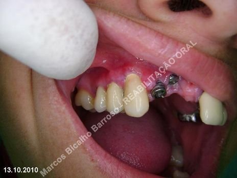 Reabilitação Oral - 10 Implantes Maxila e Mandíbula - Parte Iii - Aumento de Coroa Clínica, Corrigindo Dvo Dentes 13,14,15