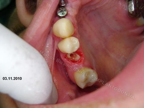 Reabilitação Oral - 10 Implantes Maxila e Mandíbula - Parte Iii - Aumento de Coroa Clínica, Corrigindo Dvo Dentes 13,14,15