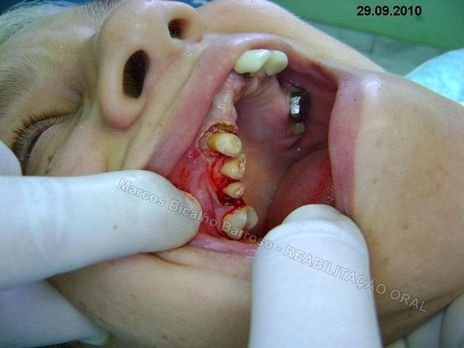 Reabilitação Oral - 10 Implantes Maxila e Mandíbula - Parte Iii - Aumento de Coroa Clínica, Corrigindo Dvo Dentes 13,14,15