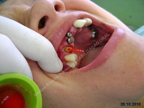 Reabilitação Oral - 10 Implantes Maxila e Mandíbula - Parte Iii - Aumento de Coroa Clínica, Corrigindo Dvo Dentes 13,14,15