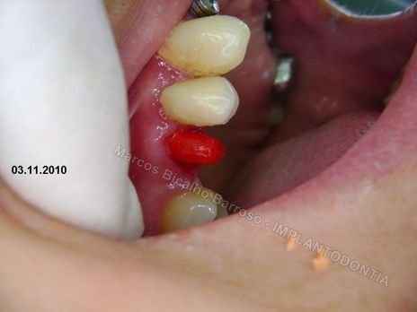 Reabilitação Oral - 10 Implantes Maxila e Mandíbula - Parte Iii - Aumento de Coroa Clínica, Corrigindo Dvo Dentes 13,14,15