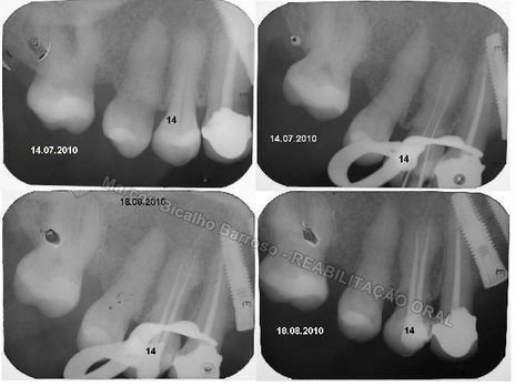 Reabilitação Oral - 10 Implantes Maxila e Mandíbula - Parte Iii - Aumento de Coroa Clínica, Corrigindo Dvo Dentes 13,14,15