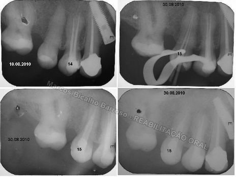 Reabilitação Oral - 10 Implantes Maxila e Mandíbula - Parte Iii - Aumento de Coroa Clínica, Corrigindo Dvo Dentes 13,14,15