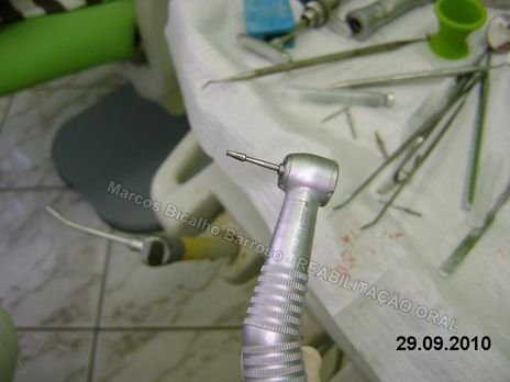 Preparando para a osteotomia. Neste caso utilizei uma broca cirúrgica, longa, carbide, da SSWhite nº FG-703SL. Para finalizar usamos também alguns cinzéis e limas para osso, mas infelizmente esqueci de fotografar.