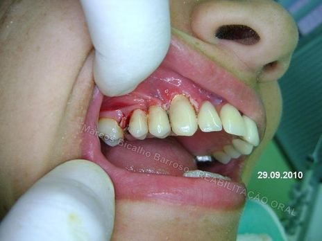 Reabilitação Oral - 10 Implantes Maxila e Mandíbula - Parte Iii - Aumento de Coroa Clínica, Corrigindo Dvo Dentes 13,14,15