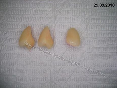 Utilizei dentes de estoque para os provisórios.