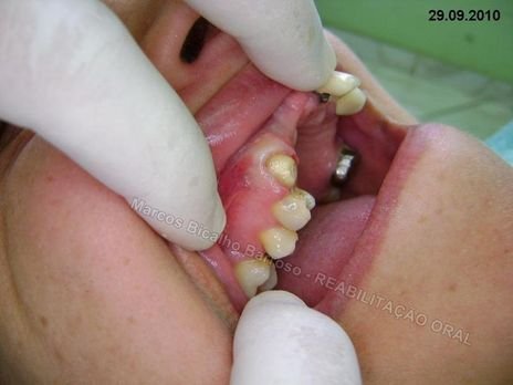 Reabilitação Oral - 10 Implantes Maxila e Mandíbula - Parte Iii - Aumento de Coroa Clínica, Corrigindo Dvo Dentes 13,14,15