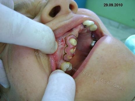 Reabilitação Oral - 10 Implantes Maxila e Mandíbula - Parte Iii - Aumento de Coroa Clínica, Corrigindo Dvo Dentes 13,14,15