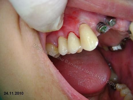 Reabilitação Oral - 10 Implantes Maxila e Mandíbula - Parte Iii - Aumento de Coroa Clínica, Corrigindo Dvo Dentes 13,14,15