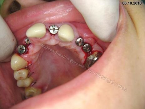 Reabiltiação Oral - 10 Implantes Maxila e Mandíbula - Parte Iv - Reabertura e Instalação dos Cicatrizadores