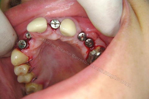 Reabiltiação Oral - 10 Implantes Maxila e Mandíbula - Parte Iv - Reabertura e Instalação dos Cicatrizadores