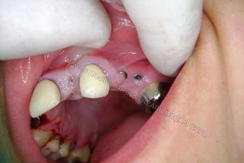 Reabiltiação Oral - 10 Implantes Maxila e Mandíbula - Parte Iv - Reabertura e Instalação dos Cicatrizadores
