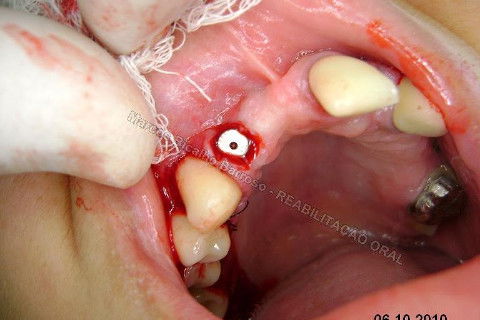 Reabiltiação Oral - 10 Implantes Maxila e Mandíbula - Parte Iv - Reabertura e Instalação dos Cicatrizadores